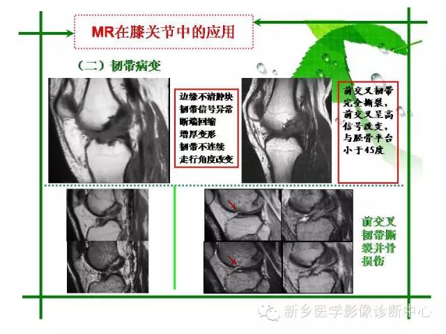 【PPT】CT和MR在骨与关节疾病的临床应用