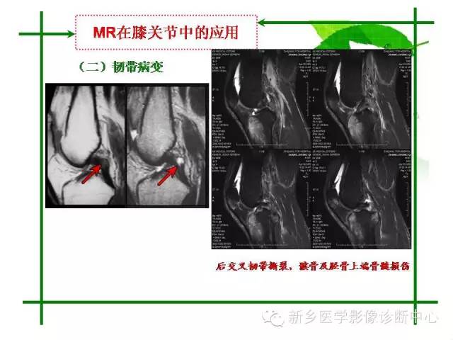 【PPT】CT和MR在骨与关节疾病的临床应用