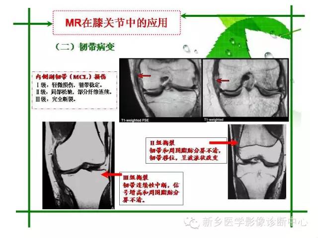 【PPT】CT和MR在骨与关节疾病的临床应用