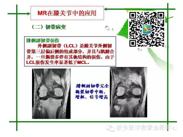 【PPT】CT和MR在骨与关节疾病的临床应用