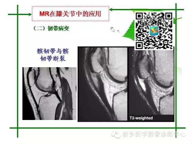 【PPT】CT和MR在骨与关节疾病的临床应用