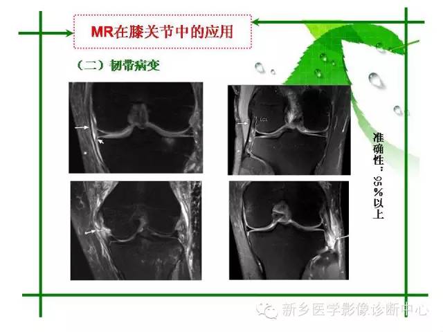 【PPT】CT和MR在骨与关节疾病的临床应用