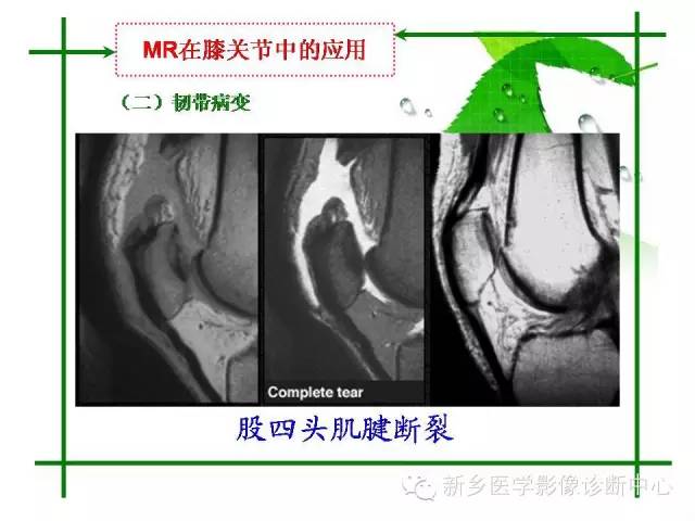 【PPT】CT和MR在骨与关节疾病的临床应用