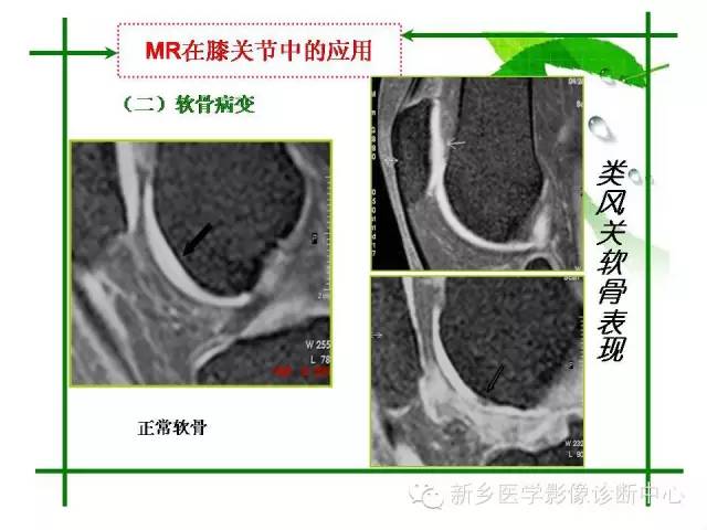 【PPT】CT和MR在骨与关节疾病的临床应用
