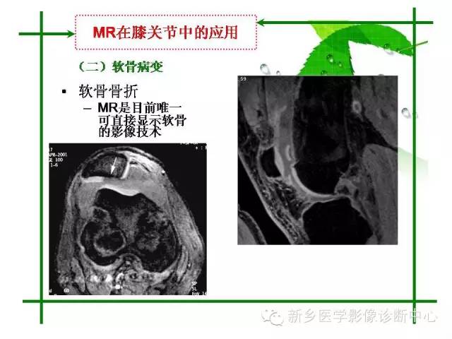 【PPT】CT和MR在骨与关节疾病的临床应用