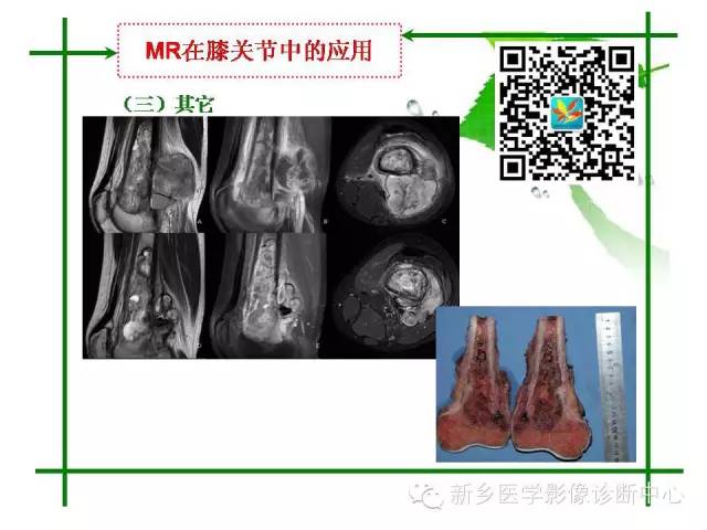 【PPT】CT和MR在骨与关节疾病的临床应用