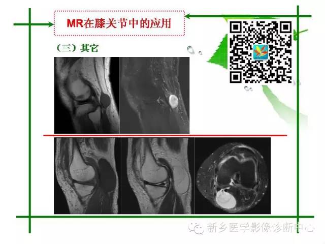 【PPT】CT和MR在骨与关节疾病的临床应用