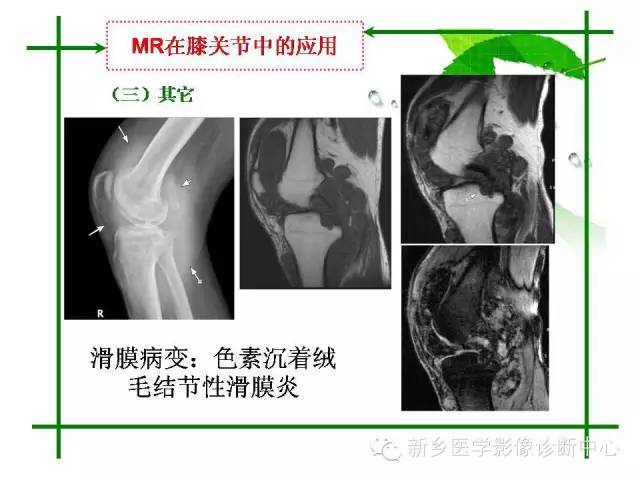 【PPT】CT和MR在骨与关节疾病的临床应用