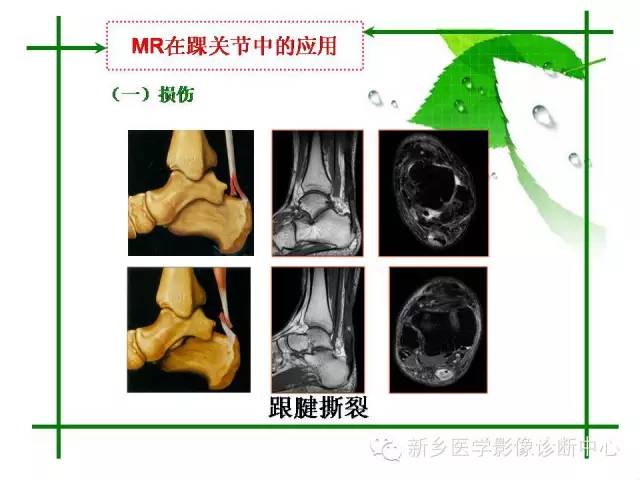 【PPT】CT和MR在骨与关节疾病的临床应用