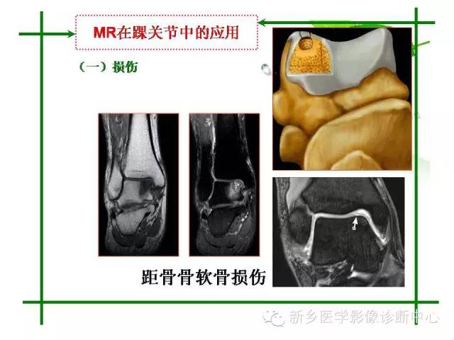 【PPT】CT和MR在骨与关节疾病的临床应用
