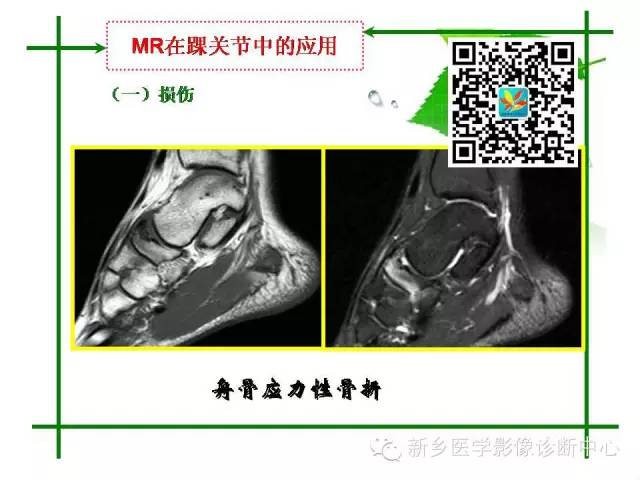 【PPT】CT和MR在骨与关节疾病的临床应用