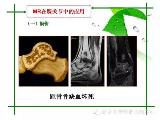 【PPT】CT和MR在骨与关节疾病的临床应用