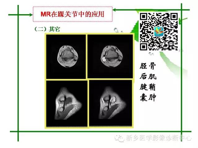 【PPT】CT和MR在骨与关节疾病的临床应用