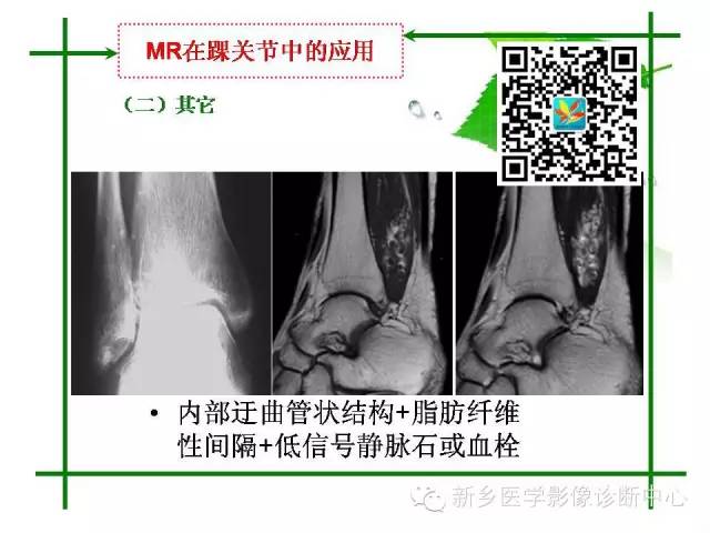 【PPT】CT和MR在骨与关节疾病的临床应用