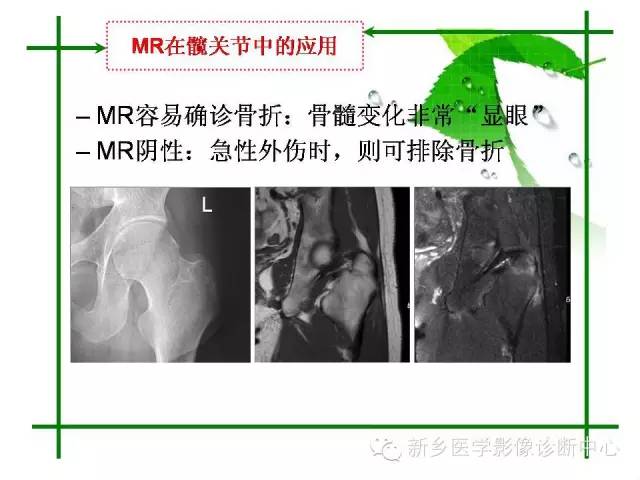 【PPT】CT和MR在骨与关节疾病的临床应用