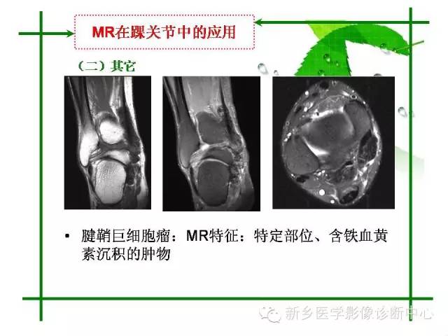 【PPT】CT和MR在骨与关节疾病的临床应用