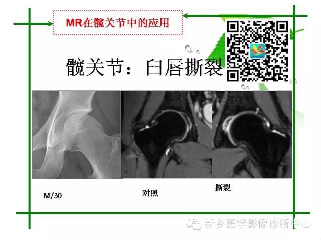 【PPT】CT和MR在骨与关节疾病的临床应用