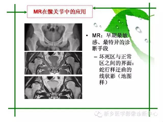 【PPT】CT和MR在骨与关节疾病的临床应用