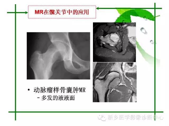 【PPT】CT和MR在骨与关节疾病的临床应用