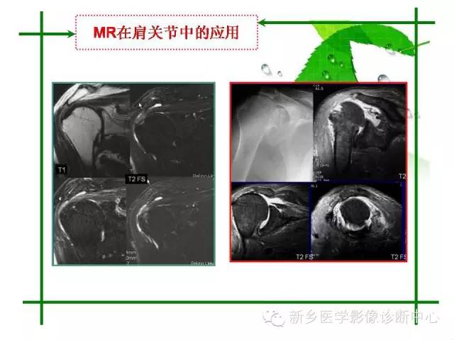 【PPT】CT和MR在骨与关节疾病的临床应用
