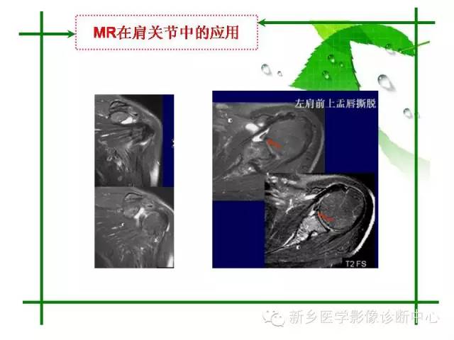 【PPT】CT和MR在骨与关节疾病的临床应用