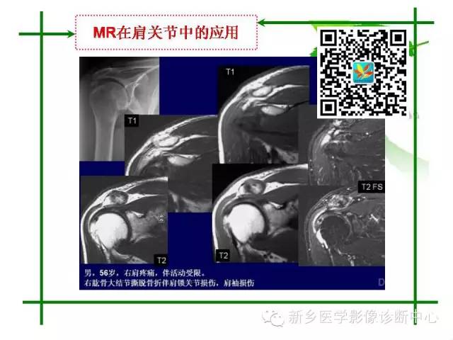 【PPT】CT和MR在骨与关节疾病的临床应用