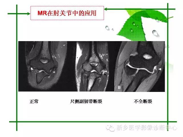 【PPT】CT和MR在骨与关节疾病的临床应用