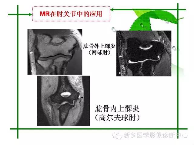 【PPT】CT和MR在骨与关节疾病的临床应用