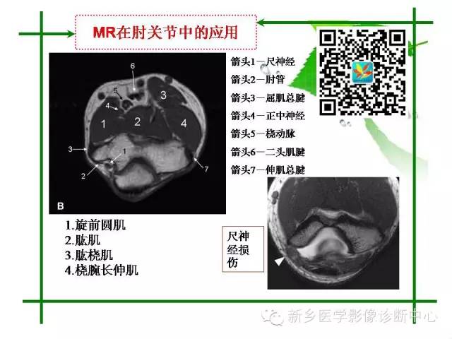 【PPT】CT和MR在骨与关节疾病的临床应用