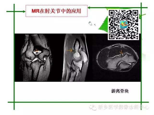 【PPT】CT和MR在骨与关节疾病的临床应用