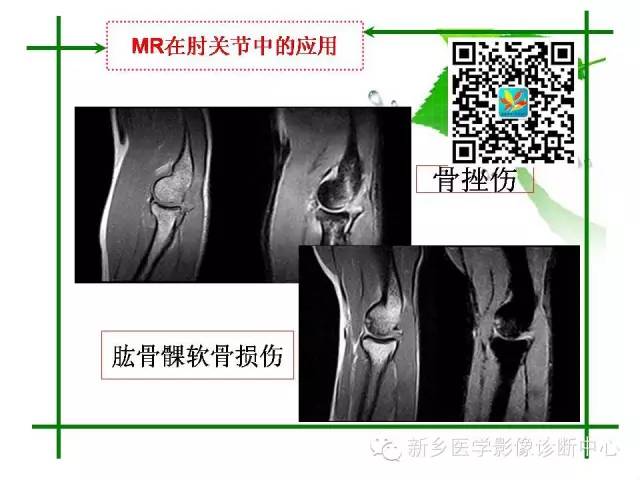 【PPT】CT和MR在骨与关节疾病的临床应用