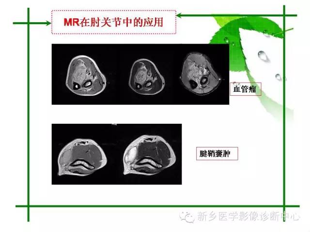【PPT】CT和MR在骨与关节疾病的临床应用