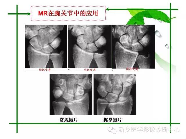 【PPT】CT和MR在骨与关节疾病的临床应用