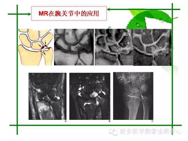 【PPT】CT和MR在骨与关节疾病的临床应用
