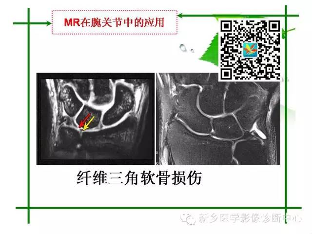【PPT】CT和MR在骨与关节疾病的临床应用