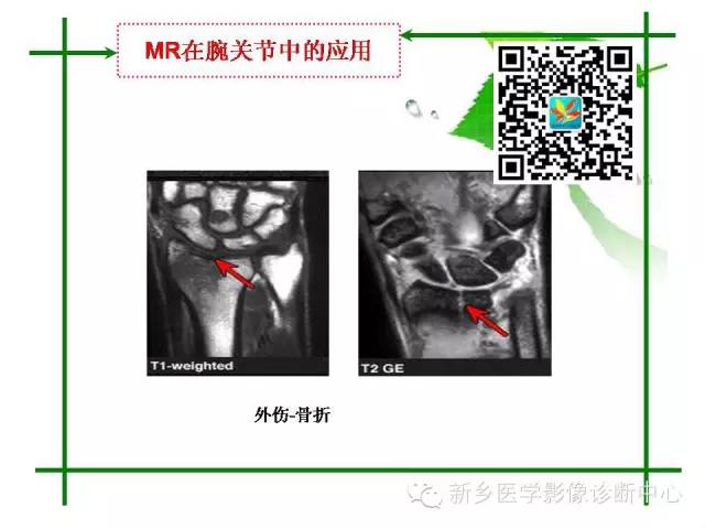 【PPT】CT和MR在骨与关节疾病的临床应用