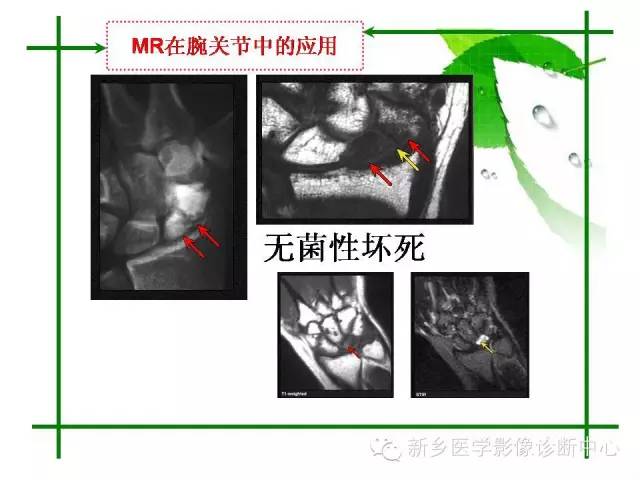 【PPT】CT和MR在骨与关节疾病的临床应用
