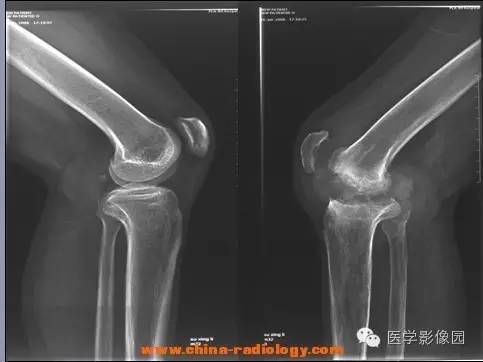 【病例】血友病性关节炎1例X线