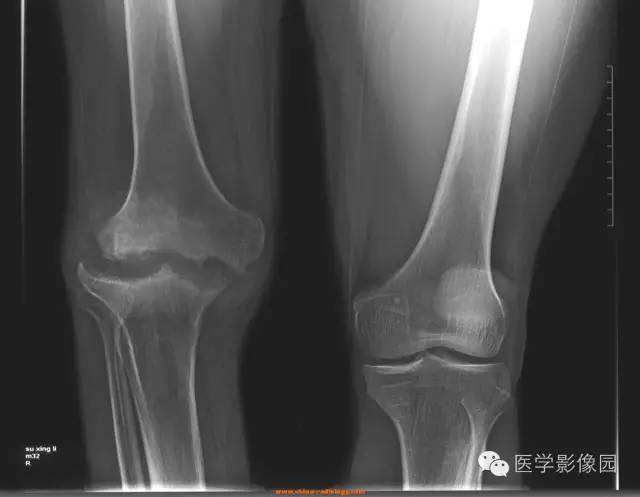 【病例】血友病性关节炎1例X线