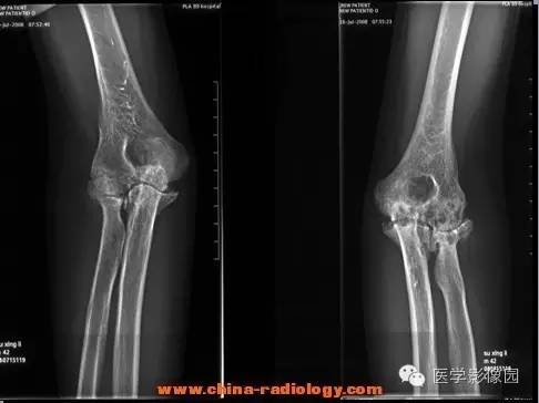 【病例】血友病性关节炎1例X线