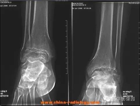 【病例】血友病性关节炎1例X线