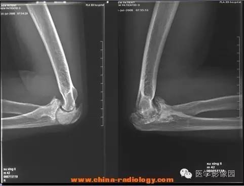 【病例】血友病性关节炎1例X线