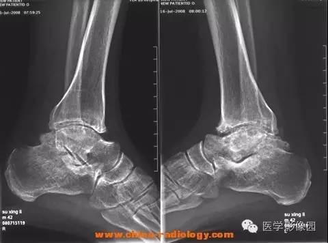【病例】血友病性关节炎1例X线