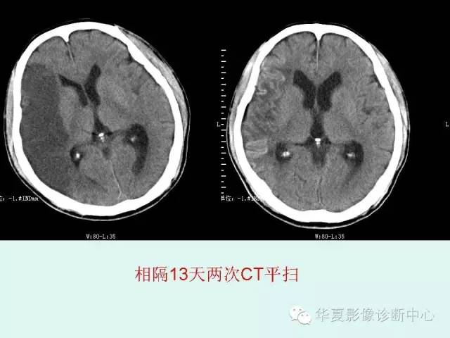 【PPT】脑皮质层状坏死的影像表现