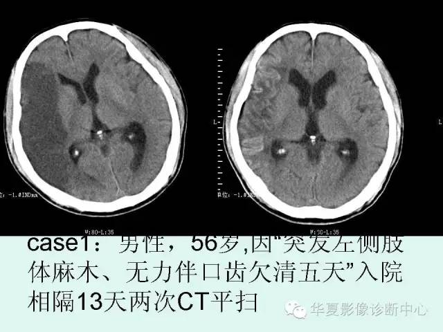 【PPT】脑皮质层状坏死的影像表现