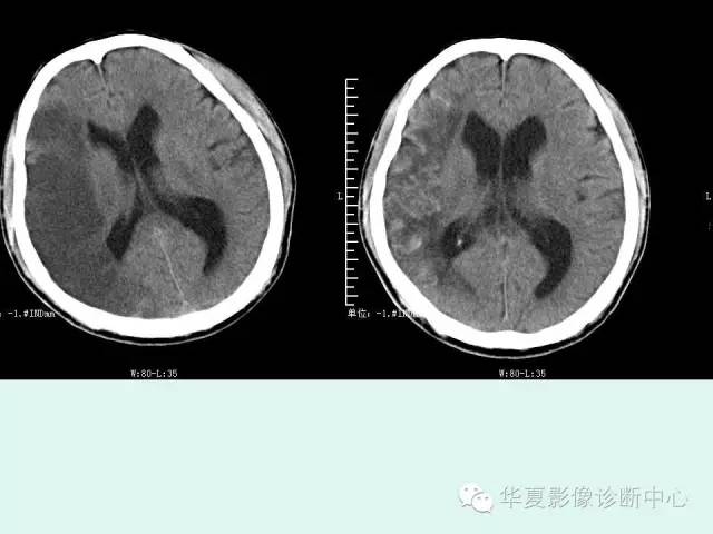 【PPT】脑皮质层状坏死的影像表现