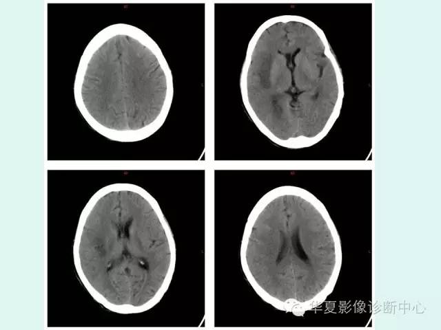 【PPT】脑皮质层状坏死的影像表现