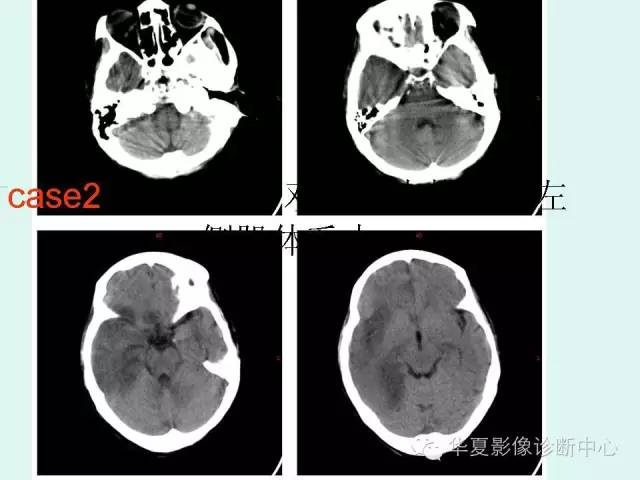 【PPT】脑皮质层状坏死的影像表现