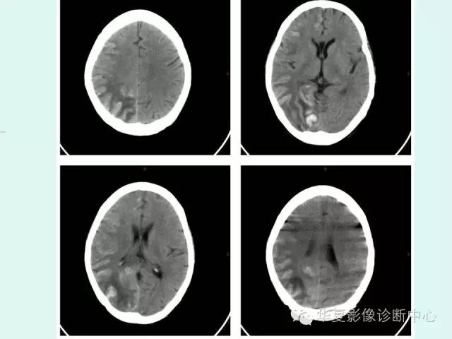 【PPT】脑皮质层状坏死的影像表现