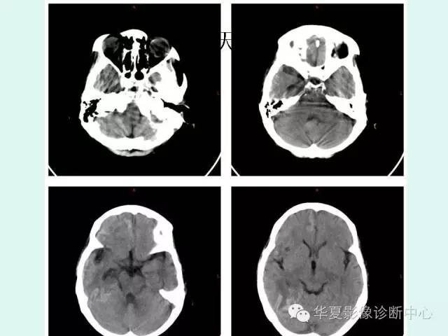 【PPT】脑皮质层状坏死的影像表现
